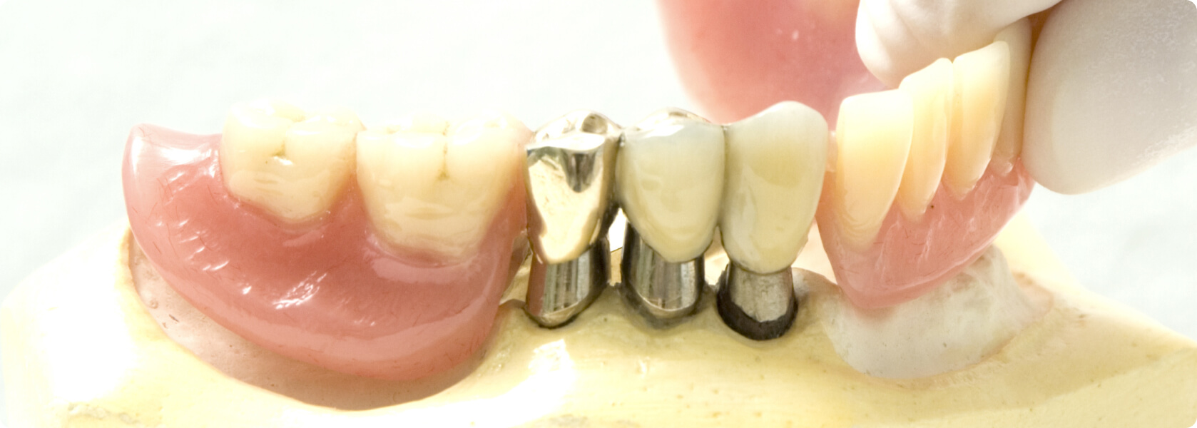 Unterkiefer teilprothese ω Zahnprothese