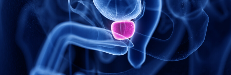 Ist der Tumor auf die Prostata begrenzt und wächst nur langsam und wenig aggressiv, kann die Erkrankung gut behandelt werden