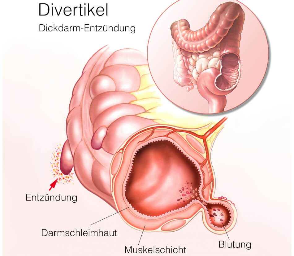 Die Divertikulitis ist eine entzündliche Darmerkrankung, die häufig als Folge einer Divertikulose entsteht. Bei der Divertikulose kommt es zu Ausstülpungen in der Darmschleimhaut