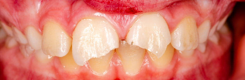 Ein Zahnunfall beschreibt eine Verletzung des Zahnapparates durch plötzliche äußere Auswirkungen wie Stürze oder Schläge.