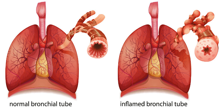 Bei Astma verengen sich die Atemwege