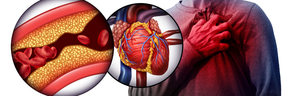 Ein Herzinfarkt entsteht durch eine unterbrochene Durchblutung.
