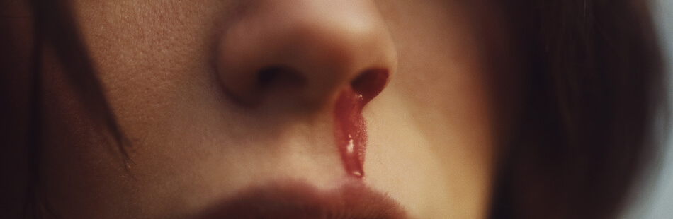 Die Immunthrombozytopenie äußert sich unter anderem durch häufiges Nasenbluten.