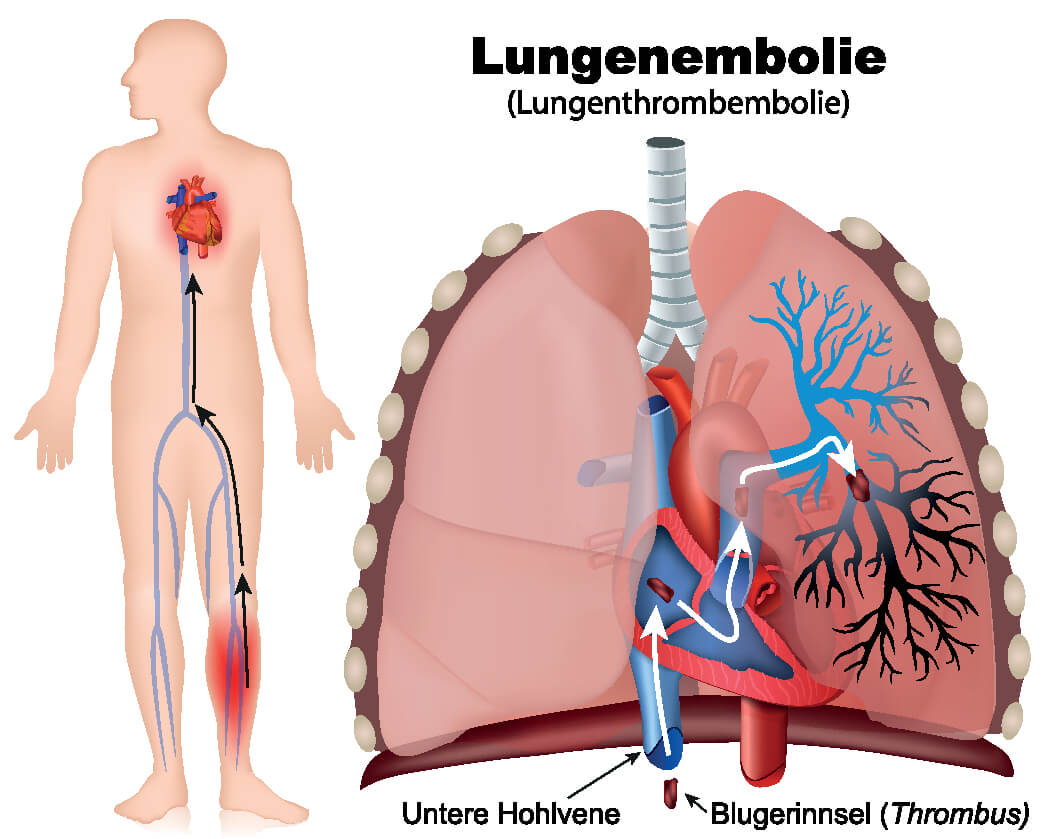 Eine Lungenembolie bezeichnet den Verschluss einer oder mehrerer Pulmonalarterien durch Blutgerinnsel.