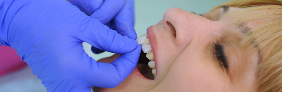 Lumineers sind hauchdünne Keramikschalen, die der Zahnarzt mit einem speziellen Klebstoff an Deinen Zähnen befestigt.