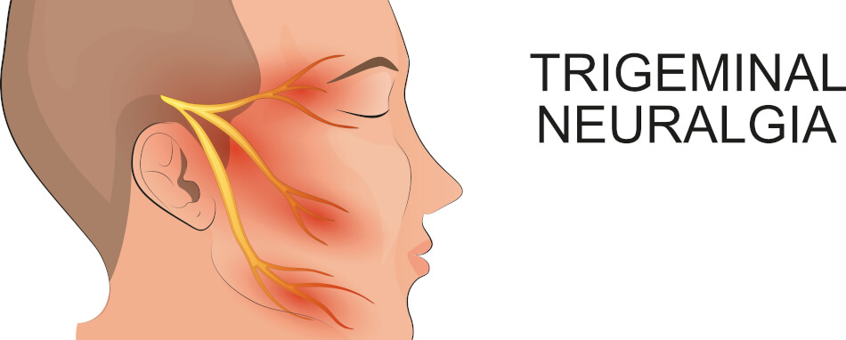 Die Schmerzen der Trigeminusneuralgie können sowohl im Stirn-, als auch im Wangen- oder Kieferbereich auftreten