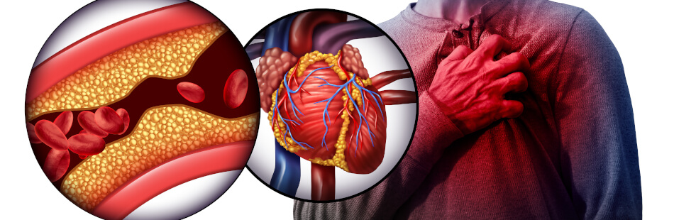 Bei einer Herzinsuffizienz kann das Herz den Körper nicht mehr mit ausreichend Blut und Sauerstoff versorgen.