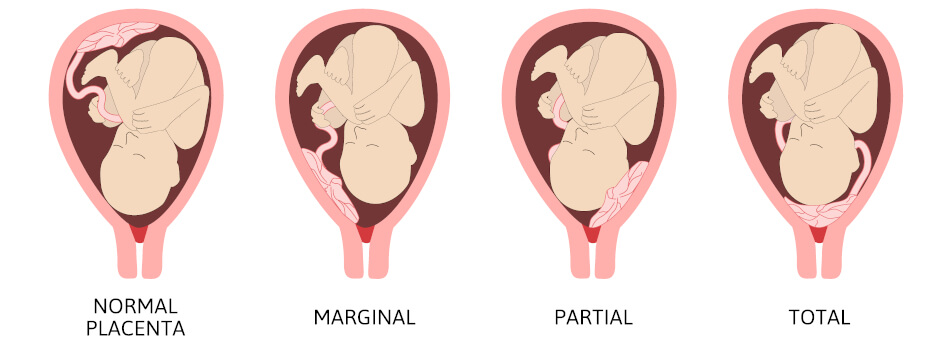 Bei der Plazenta praevia kann sich die Plazenta so verschieben, dass diese bei der Geburt als erstes rauskommt. Dadurch kann die Sauerstoffzufuhr für das ungeborene Baby gefährdet sein
