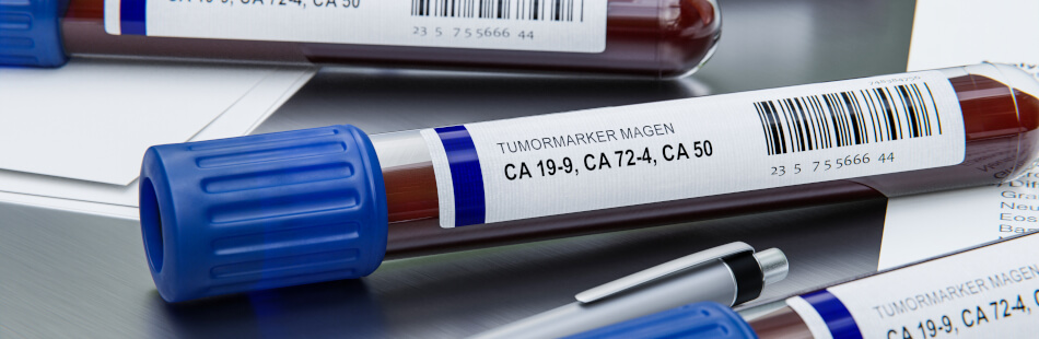Tumormarker sind bei einer Krebserkrankung ab einer gewissen Tumorgröße im Blut erhöht. Bei einem Pankreaskarzinom sind es vor allem das CA19-9, aber auch CA 50, CA 195,  CA 242, CA 72-4, sowie das CEA (carcinoembryonales Antigen)