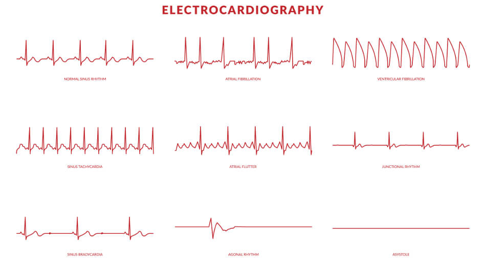 Mit einem EKG kann der Arzt die Herzfrequenz, die zwischen 60 und 100 Schläge pro Minute liegt, bestimmen
