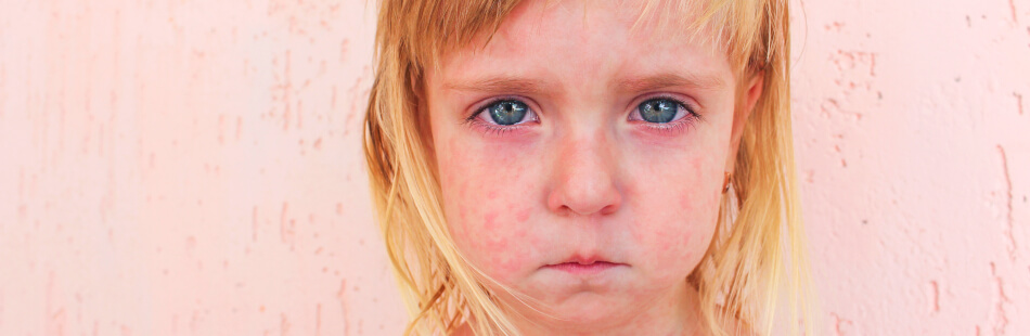 Das Kawasaki-Syndrom ist eine rheumatische Erkrankung, die vorwiegend Kinder betrifft.