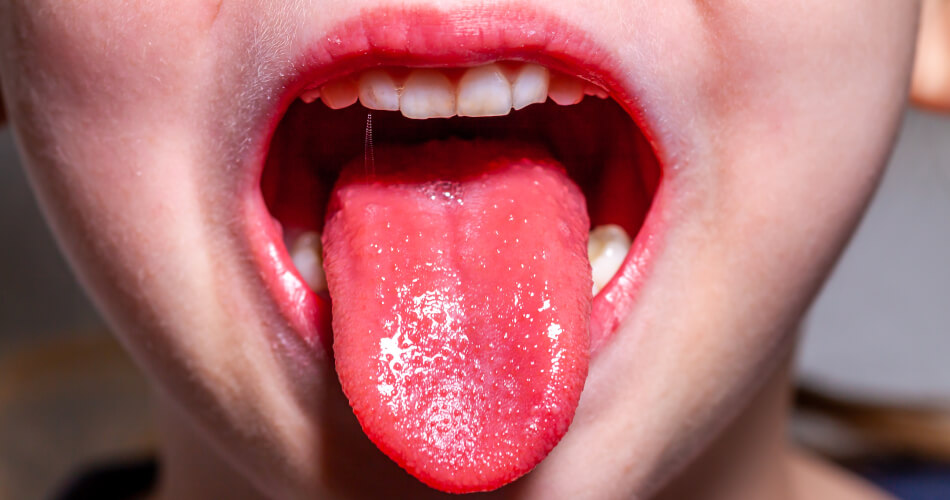 Ein Hauptsymptom beim Kawasaki-Syndrom sind Lackleppen und eine sogenannte Erdbeer- oder Himbeerzunge.