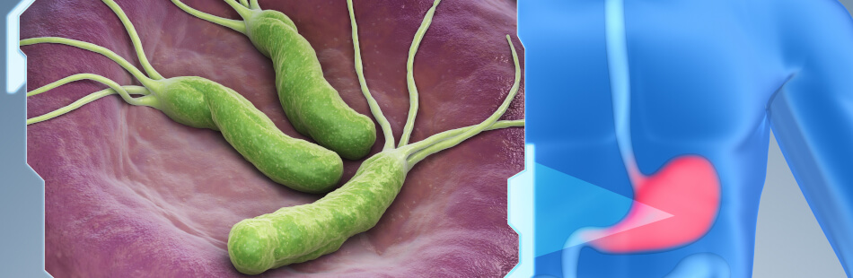 Die häufigste Ursache für ein Magengeschwür ist eine Infektion mit Helciobacter pylori-Bakterien.