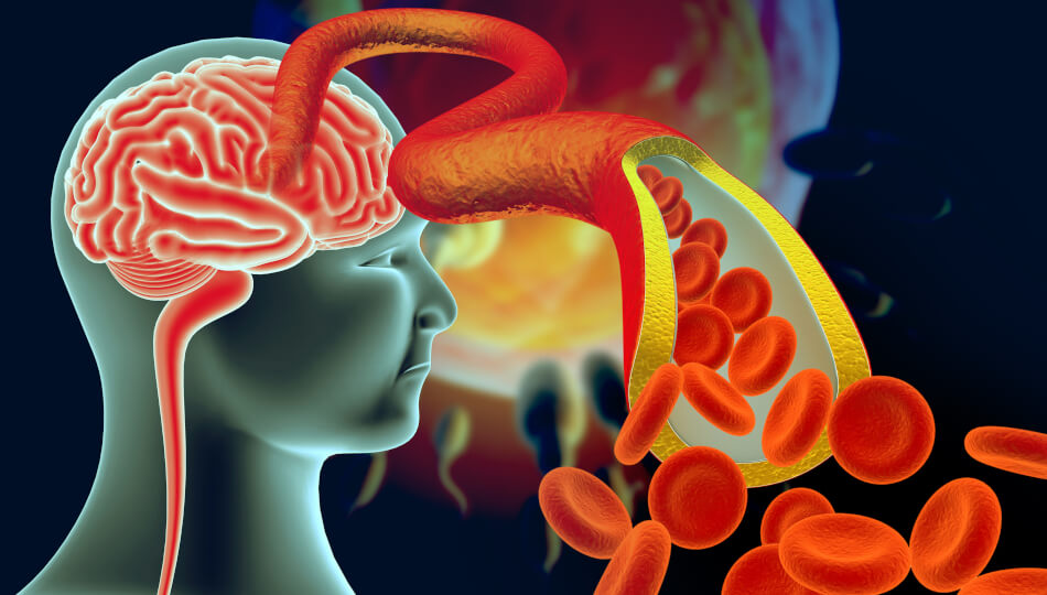 Eine Hirnblutung ist eine mögliche Folge/Komplikation bei einer Thrombozytopenie.