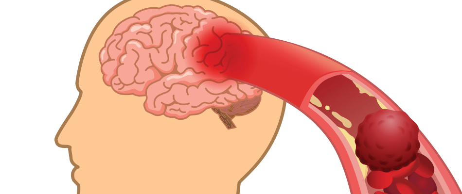 Eine transitorische ischämische Attacke, TIA, ensteht aufgrund einer Minderdurchblutung des Gehirns.
