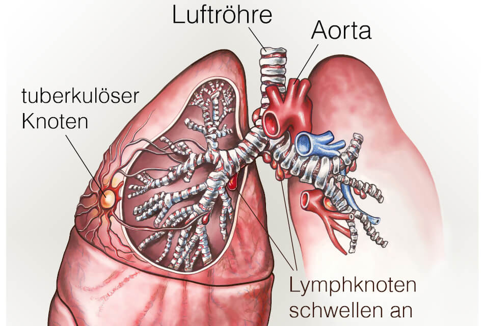 Die Lungentuberkulose ist die häufigste Form dieser Krankheit.