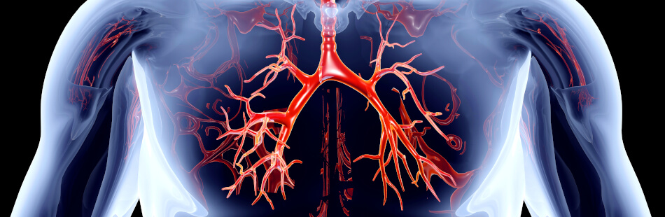 Bronchiektasen sind unheilbare Ausweitungen der Bronchien in die Lunge hinein.