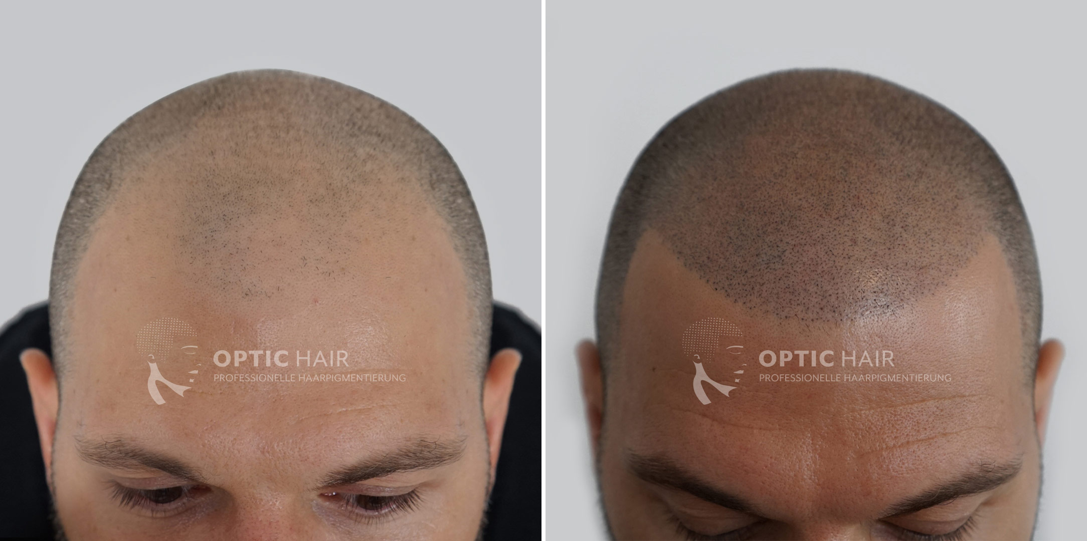 Ein neues Kapitel beginnt: Das bemerkenswerte Vorher-Nachher-Ergebnis einer Haarpigmentierung