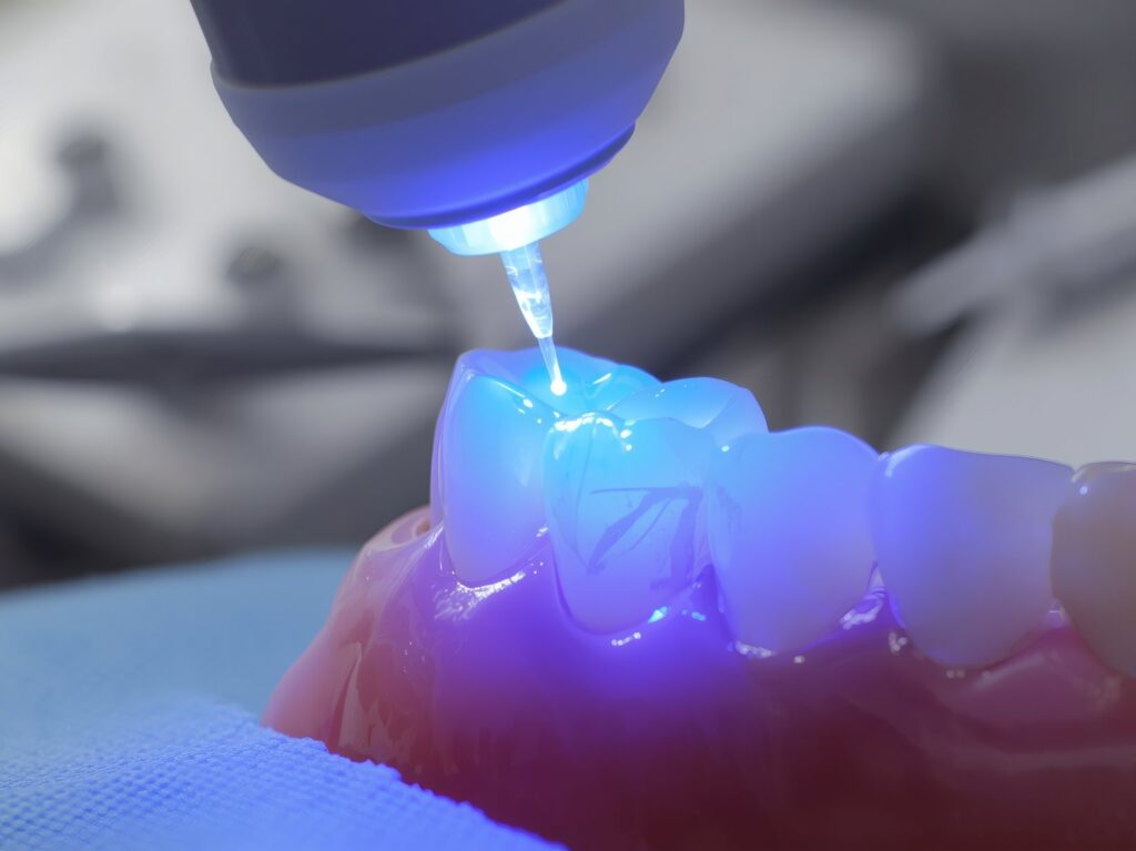 Composite Bonding Zähne