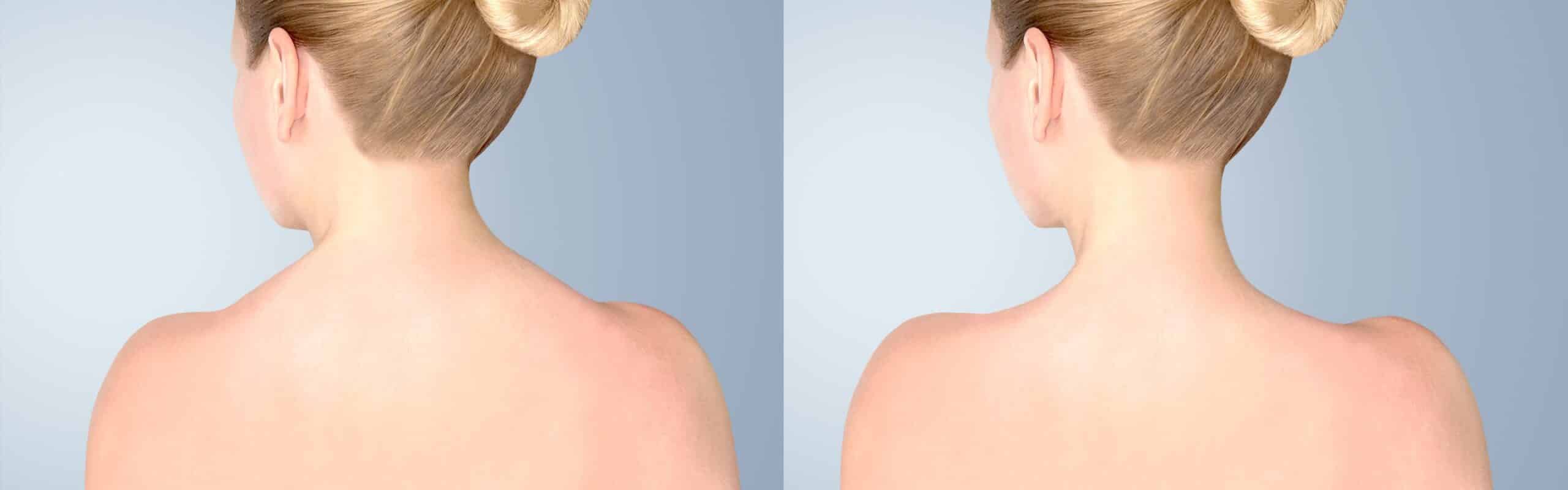 Traptox – Botulinumtoxin für die Schulterpartie