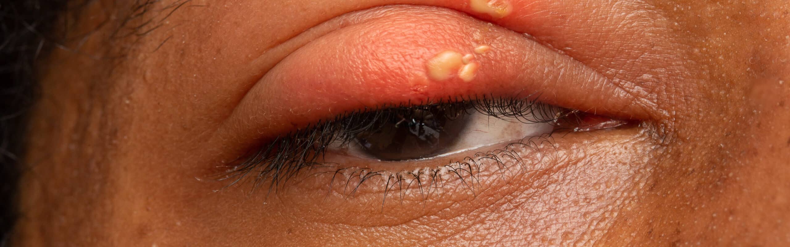 Augenherpes