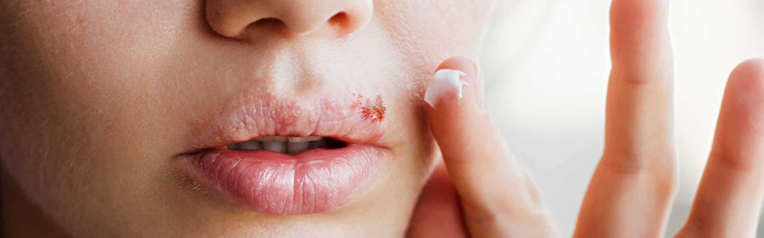 Lippenherpes