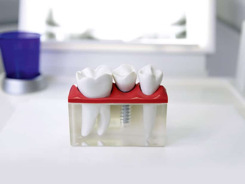 Keramikimplantate